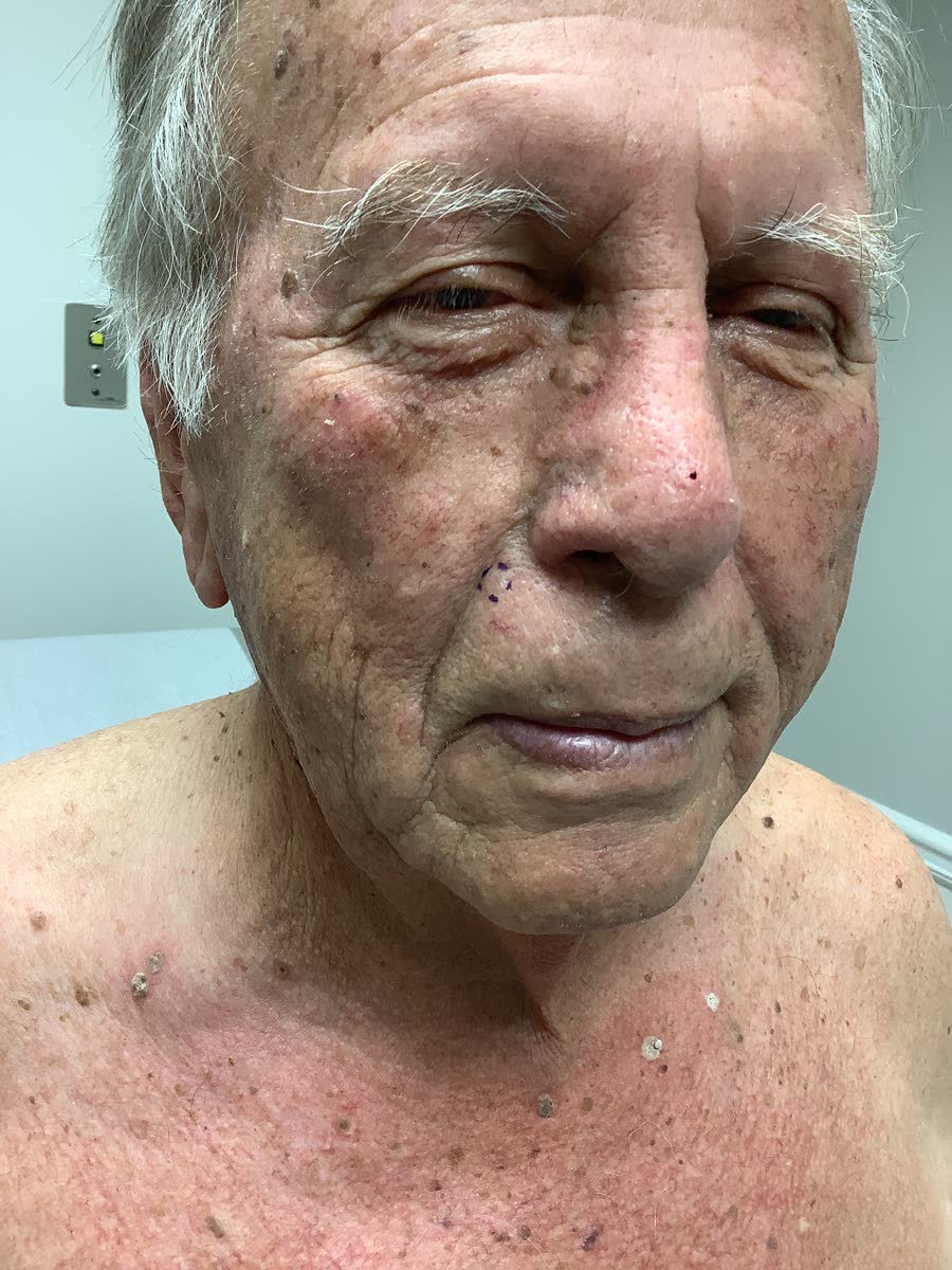 Mohs case 19 — Before: basal cell carcinoma on the right cheek