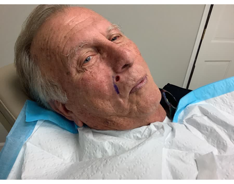 Mohs case 19 — After cancer removal: basal cell carcinoma on the right cheek