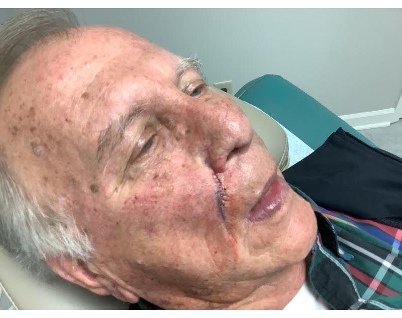 Mohs case 19 — Repair · same day: basal cell carcinoma on the right cheek