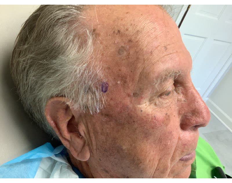 Mohs case 20 — Before: basosquamous carcinoma on the right temple