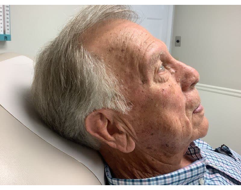 Mohs case 20 — Healed: basosquamous carcinoma on the right temple