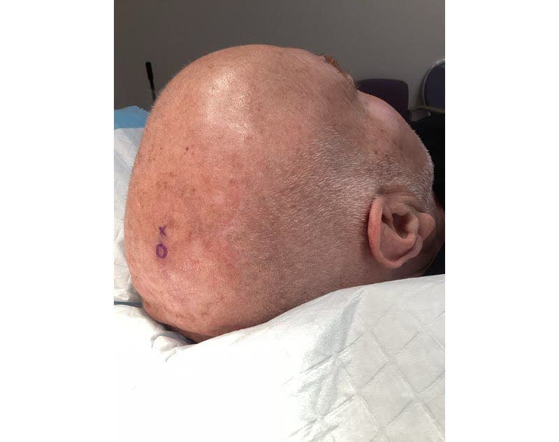 Mohs case 21 — Before: squamous cell carcinoma on the right scalp