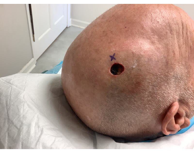 Mohs case 21 — After cancer removal: squamous cell carcinoma on the right scalp