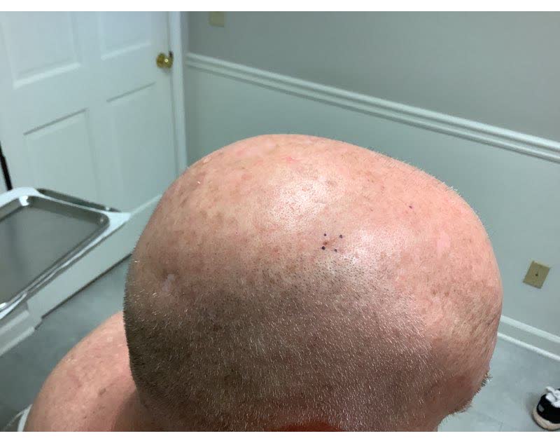 Mohs case 21 — Healed: squamous cell carcinoma on the right scalp