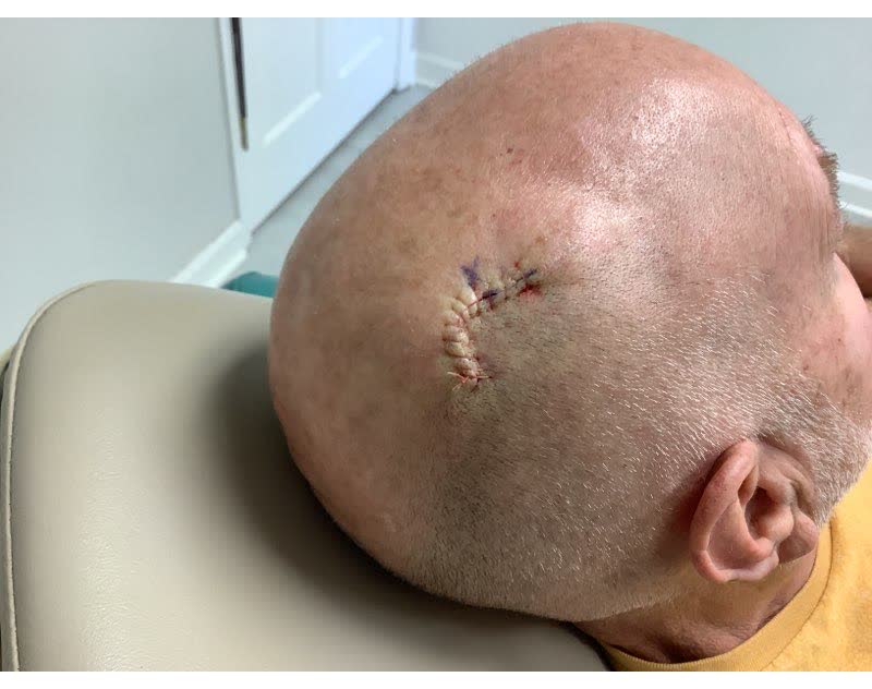 Mohs case 21 — Repair · same day: squamous cell carcinoma on the right scalp