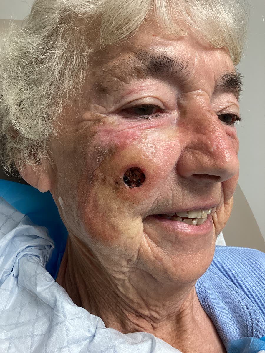 Mohs case 22 — Before: squamous cell carcinoma on the right cheek