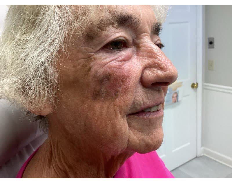 Mohs case 22 — Healed: squamous cell carcinoma on the right cheek