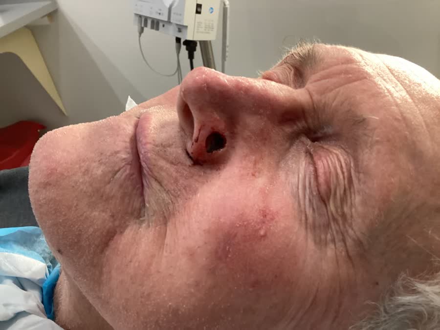 Mohs case 23 — After cancer removal: basal cell carcinoma on the nose repaired with a skin graft